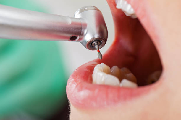 Best Emergency Tooth Extraction in Lavonia, GA